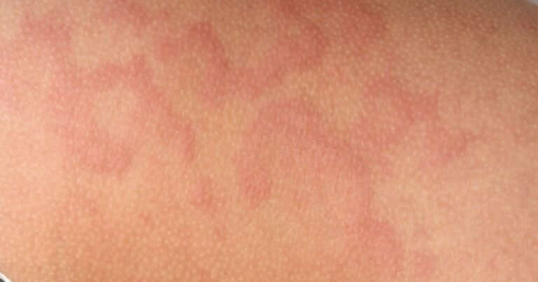 Orticaria cronica: quando i pomfi non passano