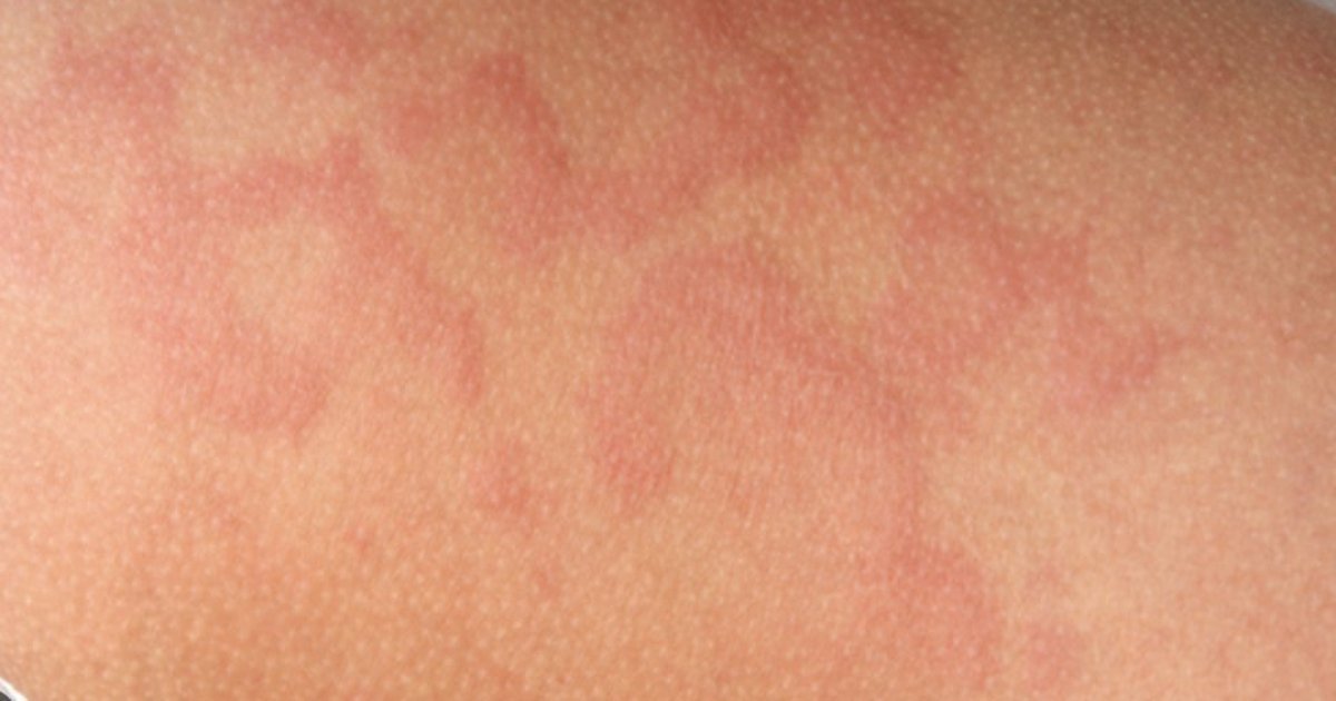 Orticaria cronica: pomfi rossi sulla pelle