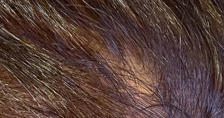 Alopecia da stress: quando la caduta dei capelli è davvero legata allo stress