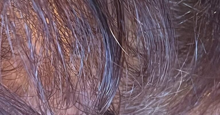 Alopecia femminile: perdita di capelli nelle donne, cause e cosa fare