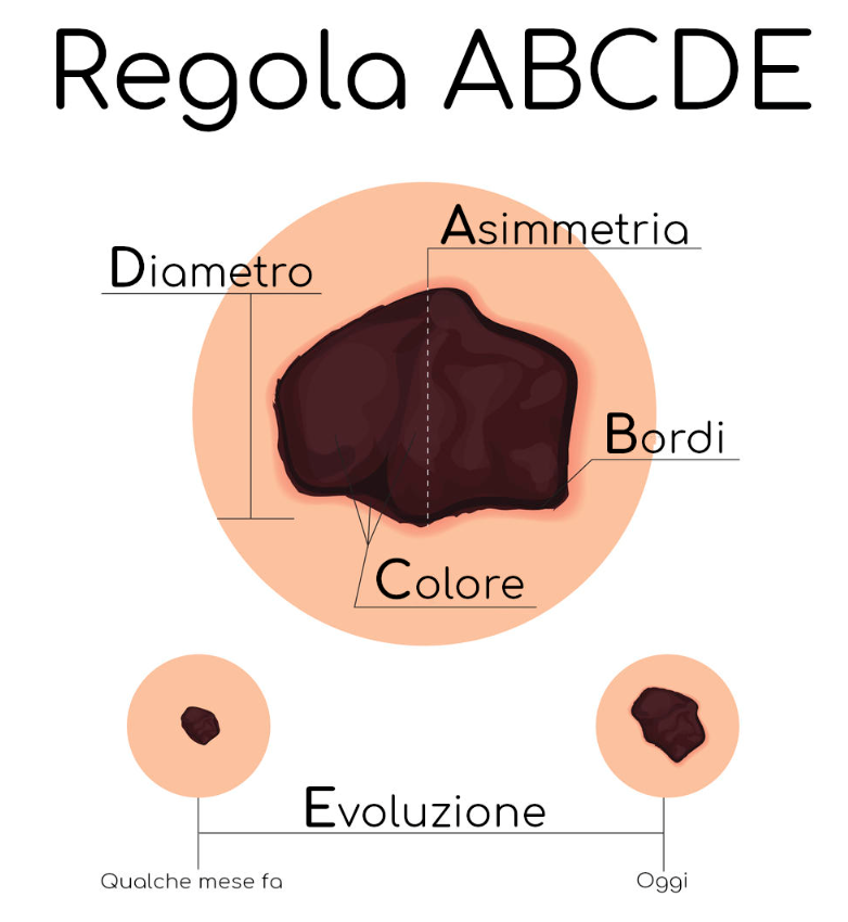 Regola ABCDE: asimmetria, bordi, colore, diametro ed evoluzione di un neo
