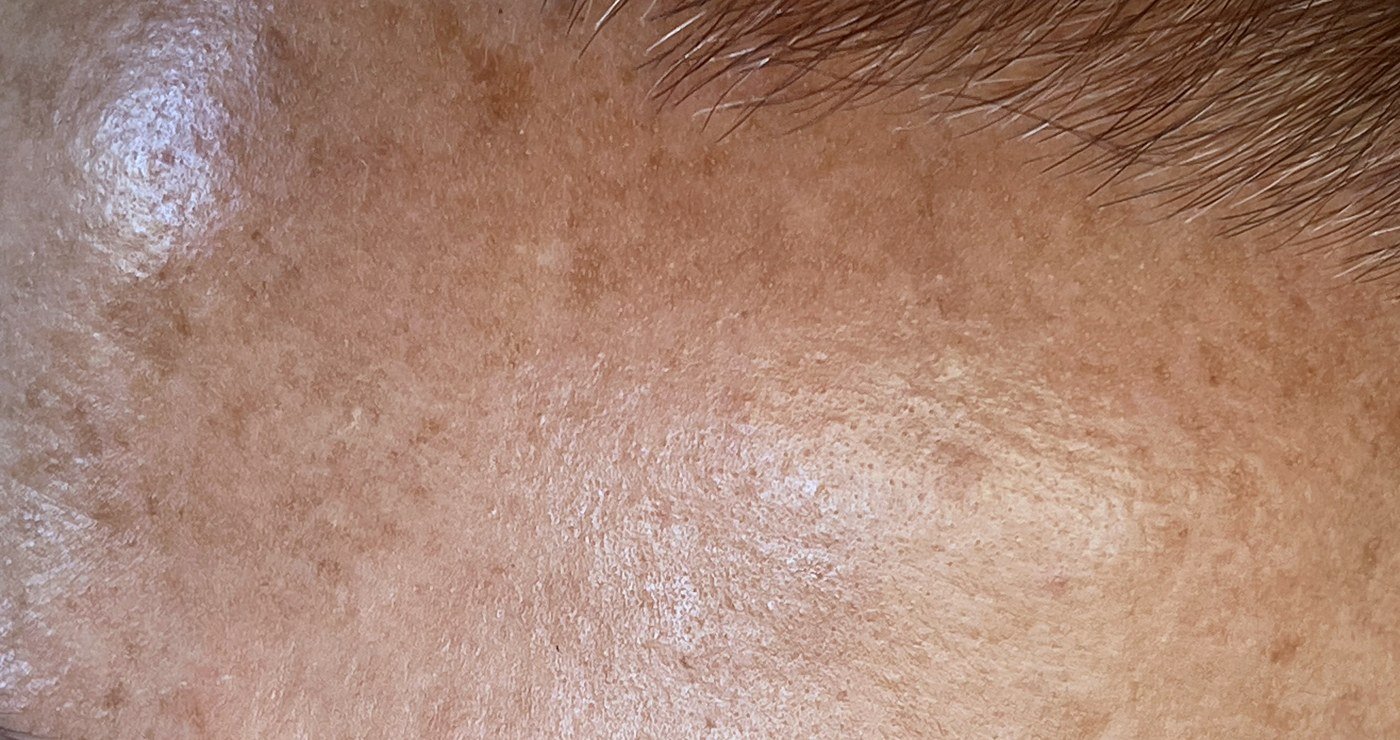 Melasma sulla fronte: macchie scure a chiazze dai bordi irregolari