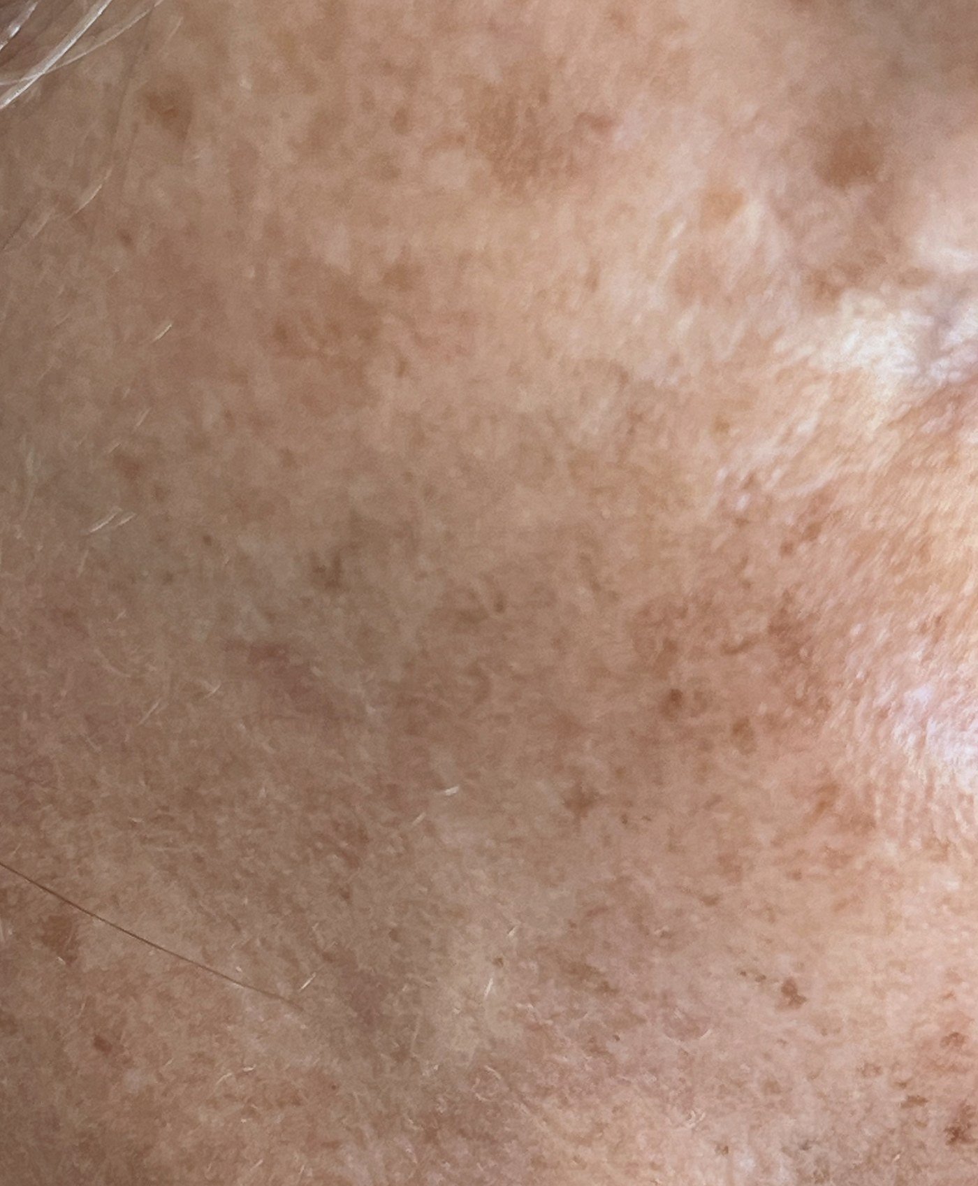 Melasma su guancia e zigomo: macchie brune diffuse sul viso