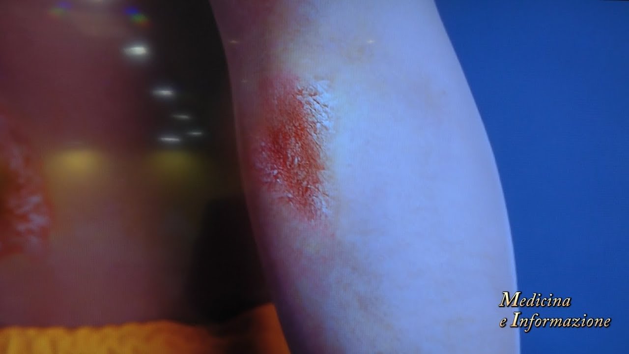 Psoriasi moderata-grave: un nuovo farmaco per uso orale