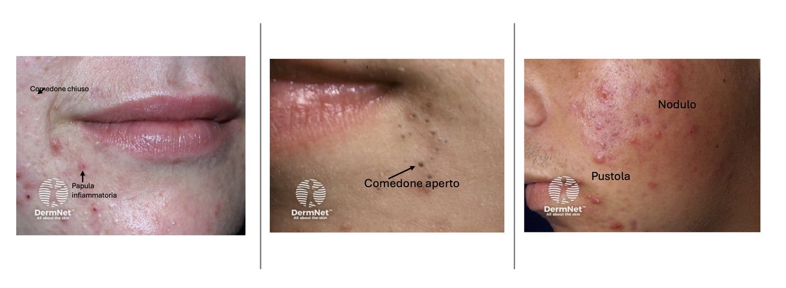 Immagine illustrativa, Acne