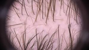 Immagine illustrativa, Alopecia androgenetica