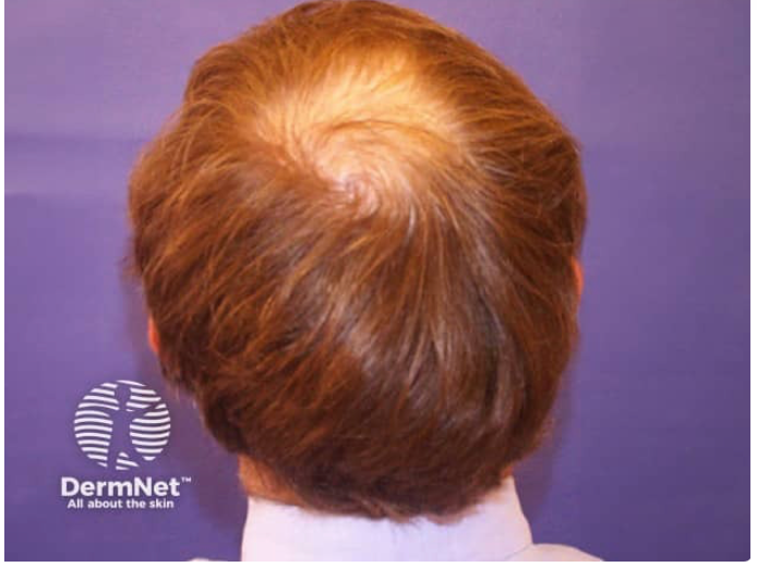 Immagine illustrativa, Alopecia androgenetica