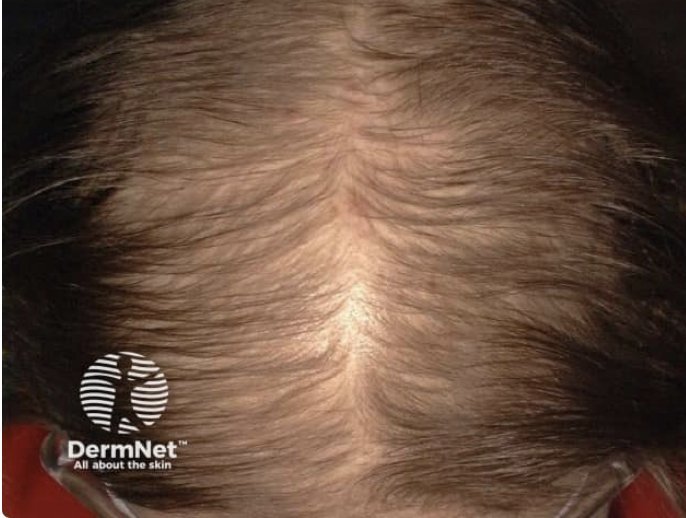 Immagine illustrativa, Alopecia androgenetica