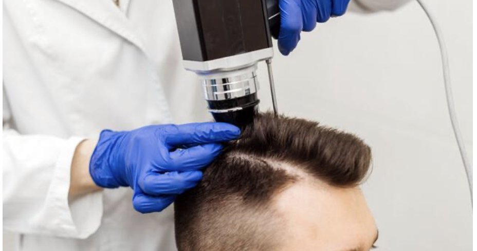 Immagine illustrativa, Alopecia
