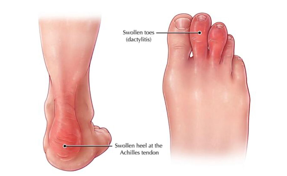Immagine illustrativa, Artrite psoriasica