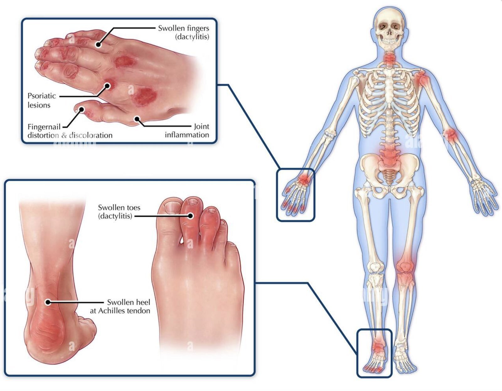 Immagine illustrativa, Artrite psoriasica