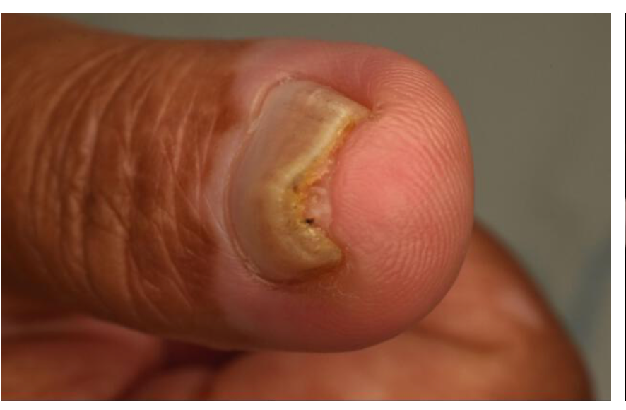 Immagine illustrativa, Artrite psoriasica