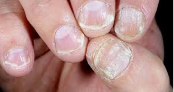 Immagine illustrativa, Artrite psoriasica