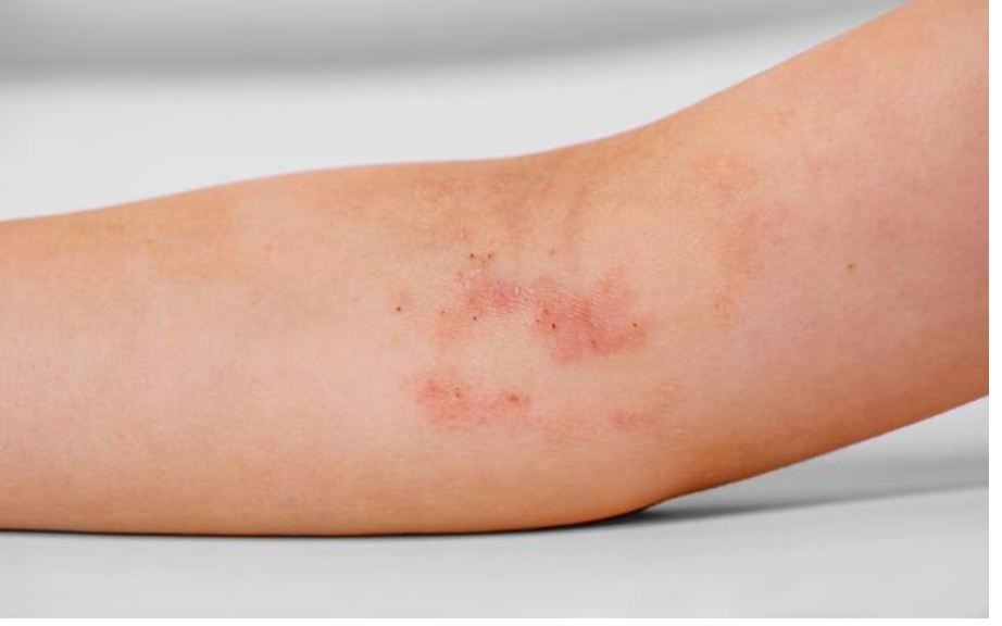 Immagine illustrativa, Dermatite atopica