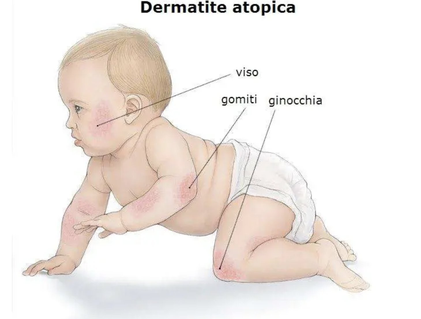 Immagine illustrativa, Dermatite atopica