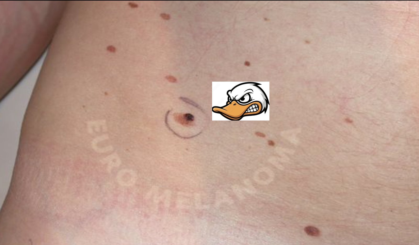 Immagine illustrativa, Melanoma
