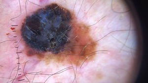 Immagine illustrativa, Melanoma