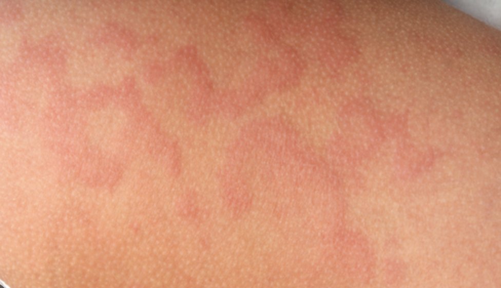 Immagine illustrativa, Orticaria