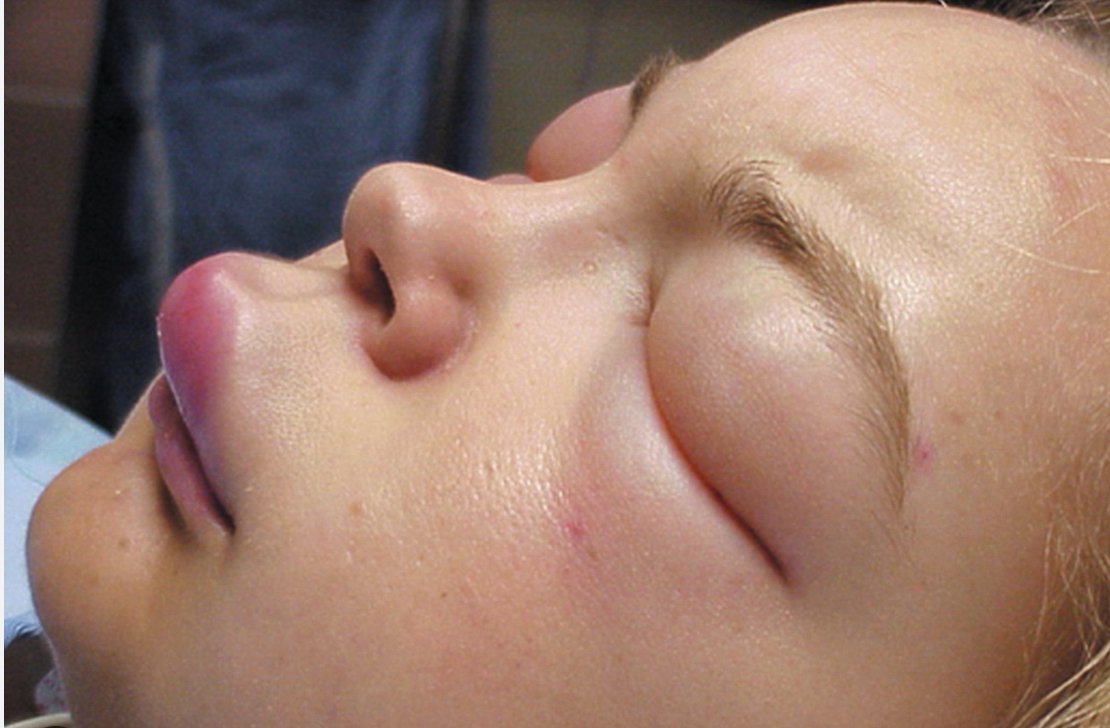 Immagine illustrativa, Orticaria