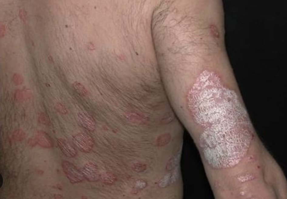Immagine illustrativa, Psoriasi