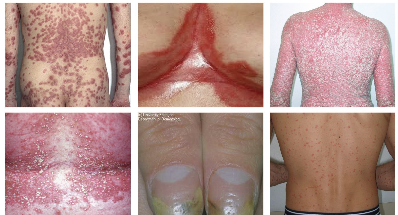 Immagine illustrativa, Psoriasi