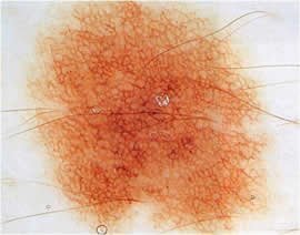 Immagine illustrativa, Dermatoscopia e mappatura dei nei